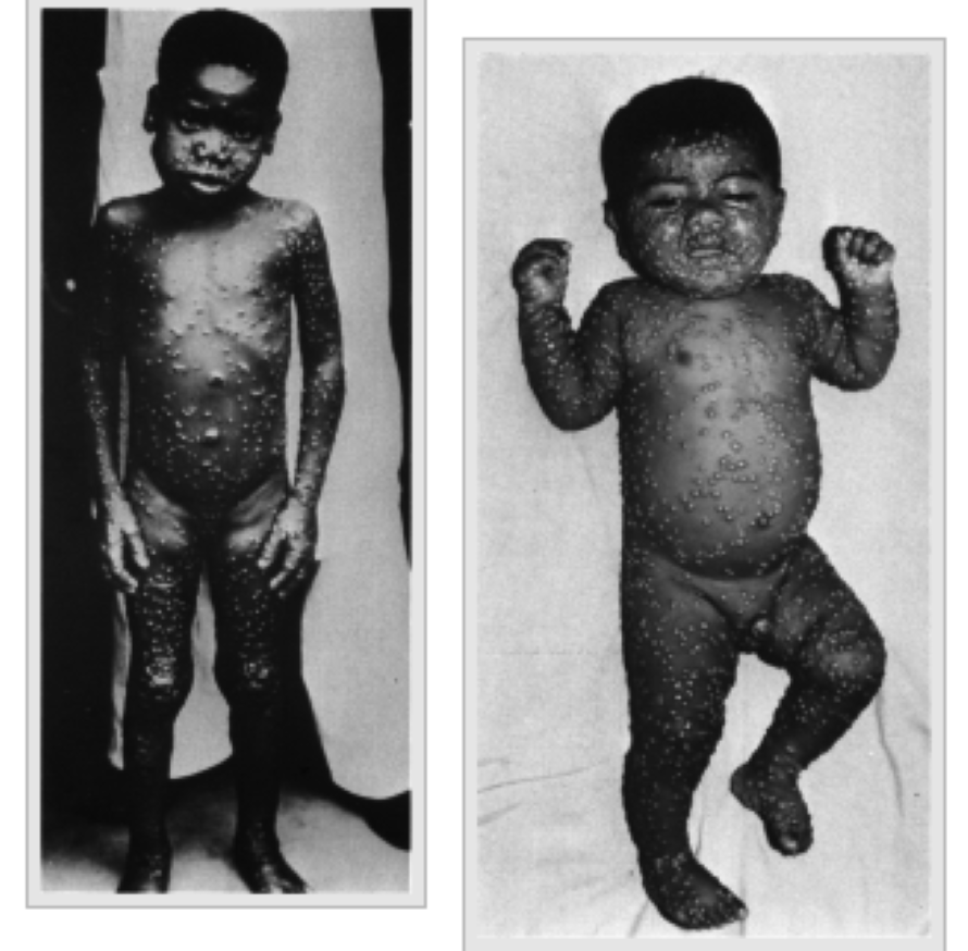 the difference between rashes caused by monkeys' Monkeypox and other diseases