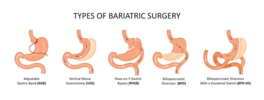for bariatric surgery is the adjustable gastric ring