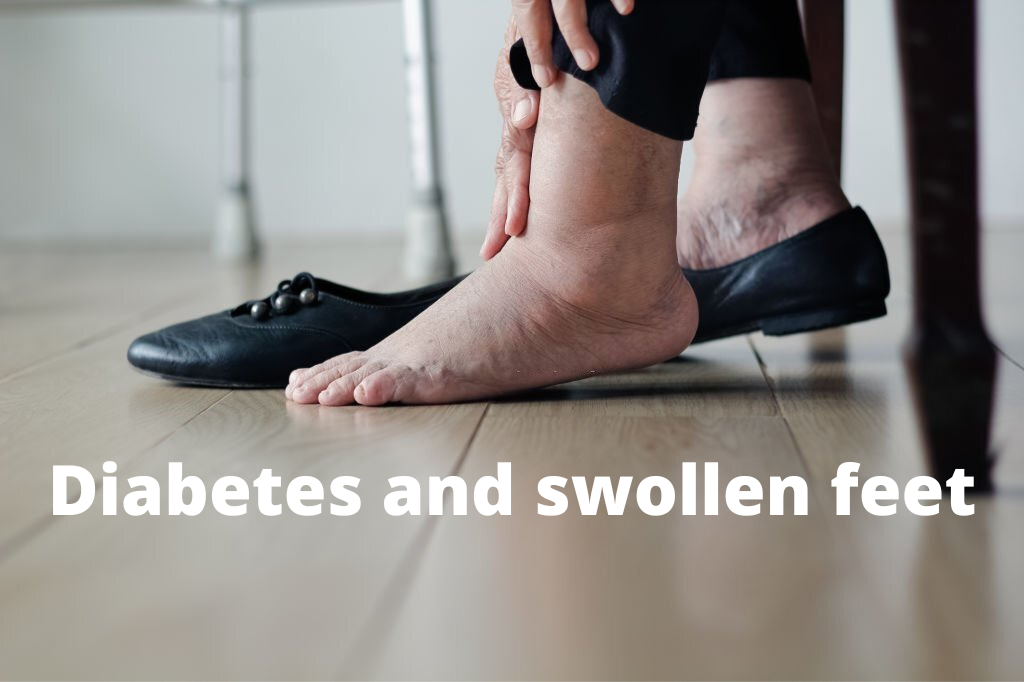 Diabetes and swollen feet