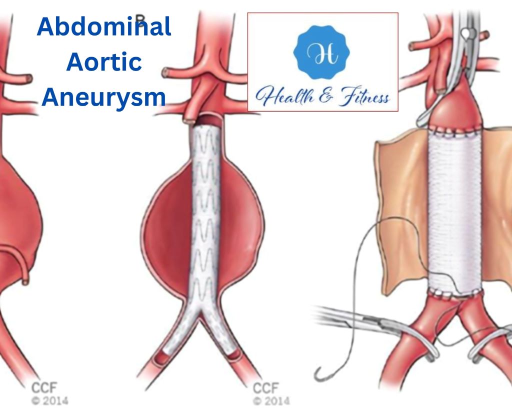 Abdominal Aortic Aneurysm