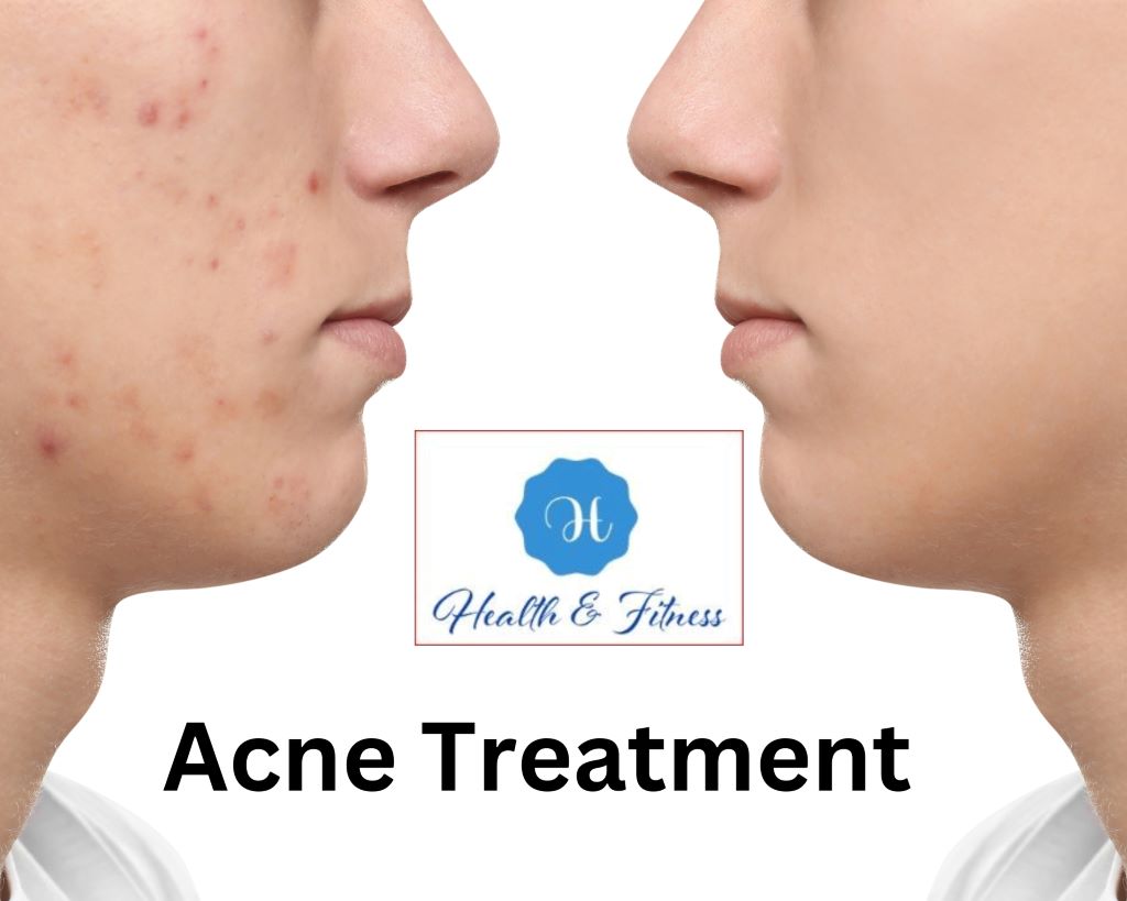 Acne Treatments That Are Currently Available
