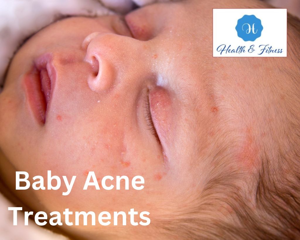 Baby Acne treatments for babies or infants and toddlers