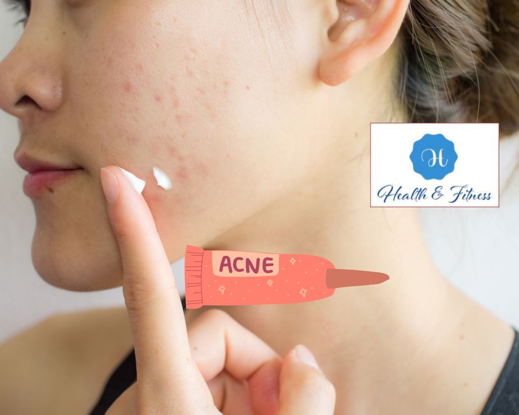 Acne 2023: Everything You Need to Know