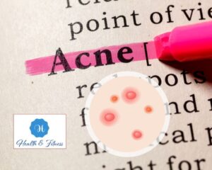 What Exactly Is Acne