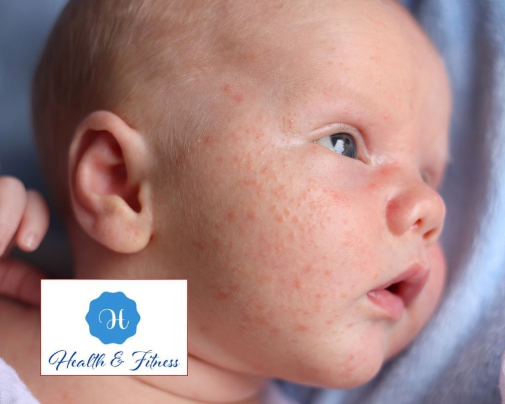 What are the causes of acne in infants or baby acne
