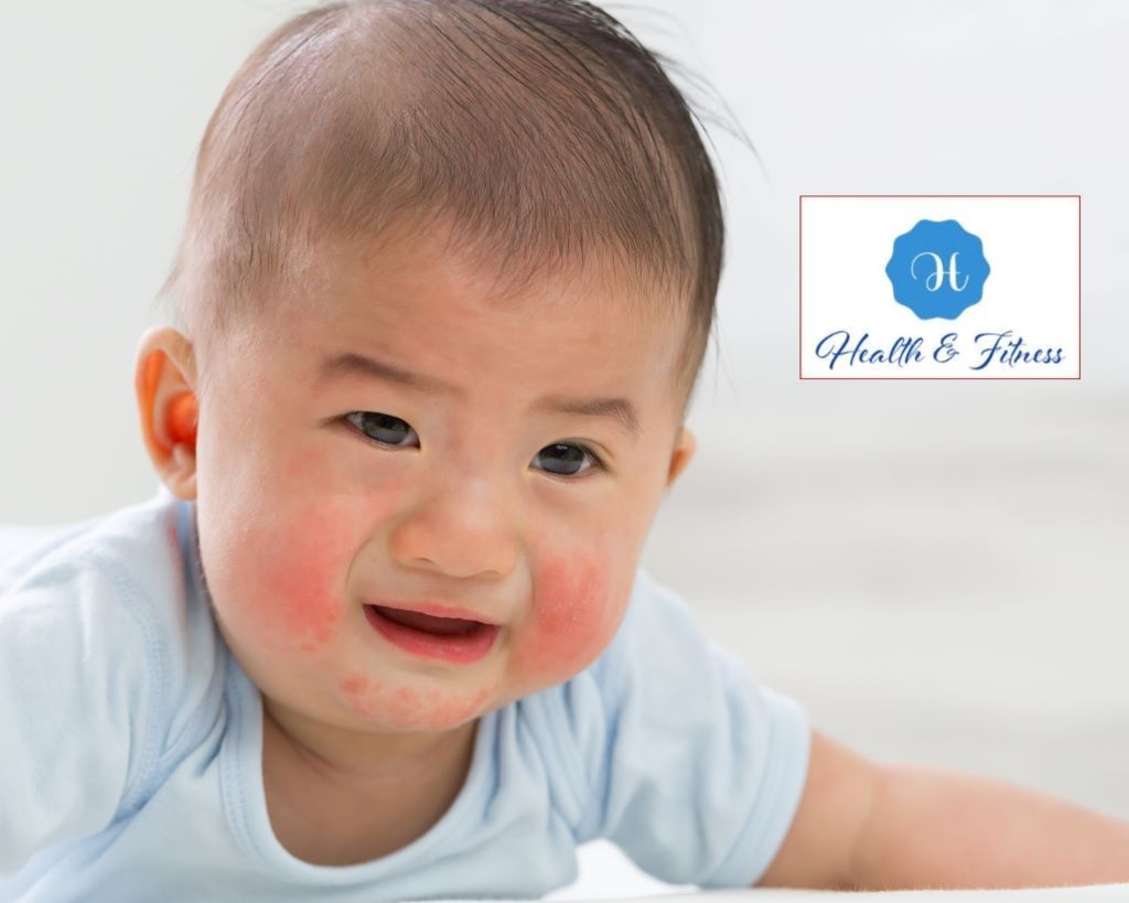 What exactly is acne in infants or baby acne