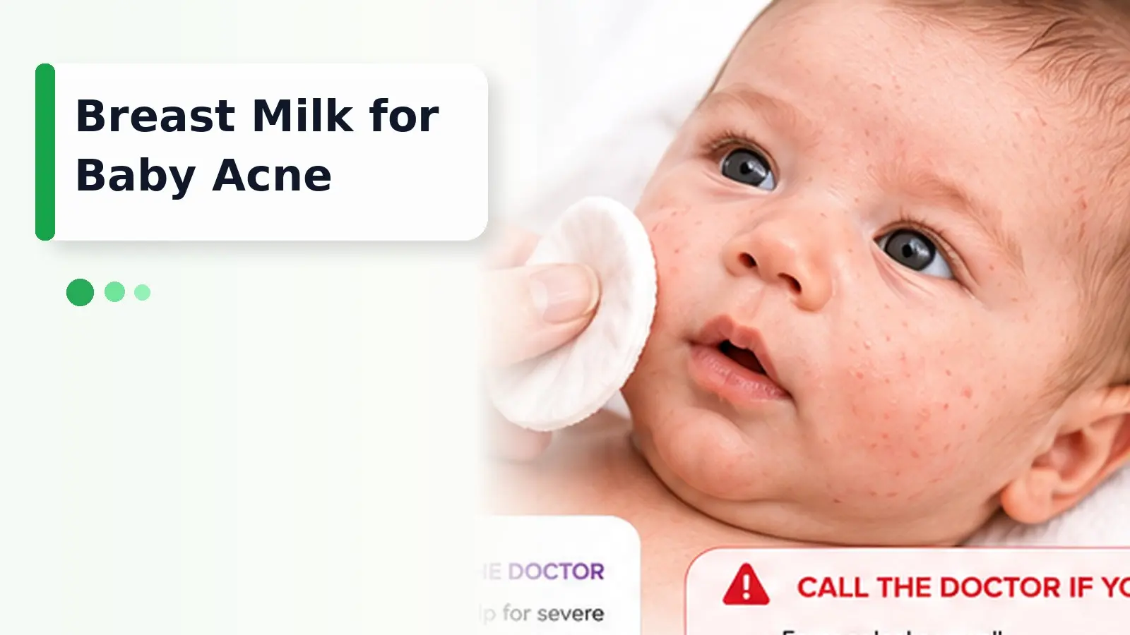 Breast Milk for Baby Acne -Breastfeeding parent holding a comfortable newborn with mild baby acne while a pediatric clinician explains gentle skin care