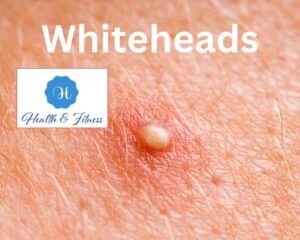 Acne best 12 tips to get rid of whiteheads