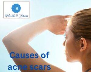 Causes of acne scars