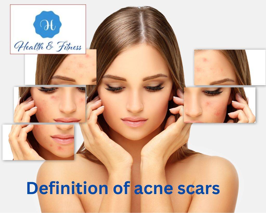 Definition of acne scars