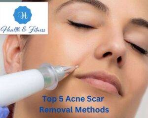 Top 5 Acne Scar Removal Methods