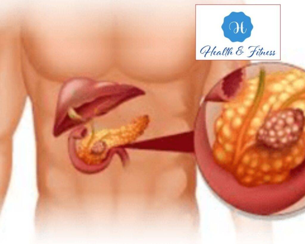 Pancreatitis Causes, Symptoms, and Treatment