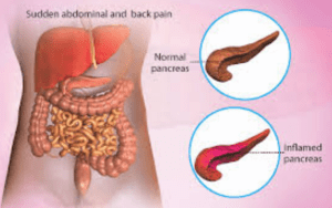 Treatment Options for Pancreatitis
