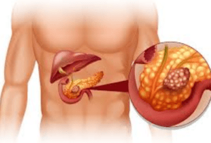 Pancreatitis Causes