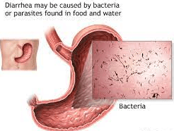 Causes of Diarrhea