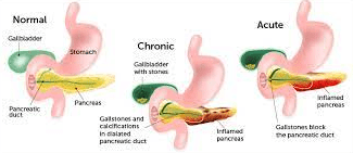 Signs and Symptoms of Pancreatitis in Children