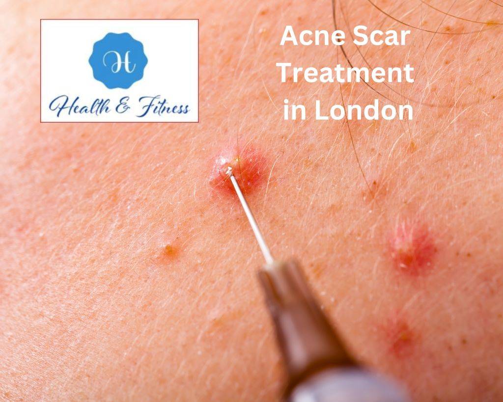 Acne Scar Treatment in London
