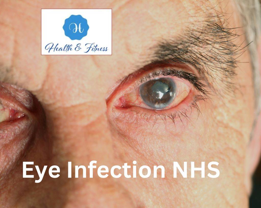 Eye Infection NHS Your Ultimate Guide to Understanding and Preventing Common Eye Problems