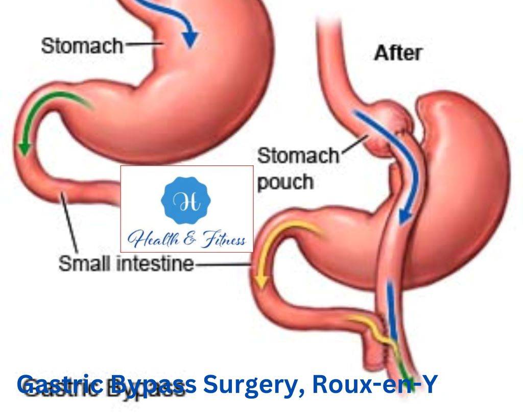 Gastric Bypass Surgery, Roux-en-Y