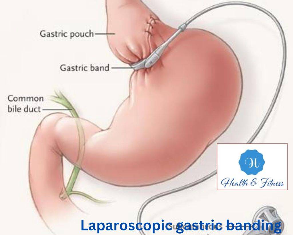 Laparoscopic gastric banding 