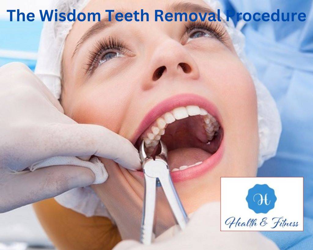 The Wisdom Teeth Removal Procedure