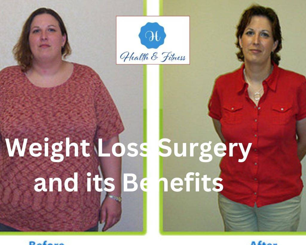 Understanding Weight Loss Surgery and its Benefits