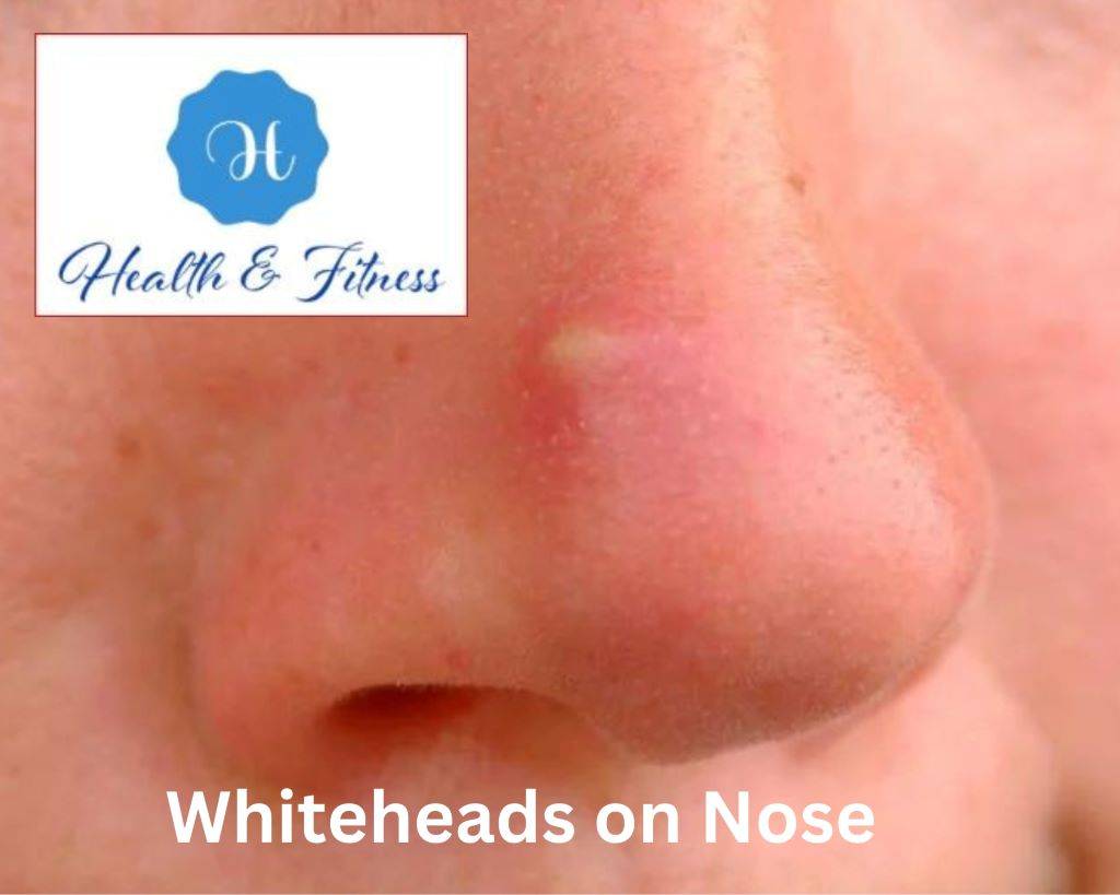 Whiteheads on Nose Causes Prevention, and Treatment Options