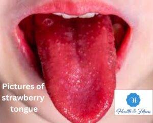 Pictures of strawberry tongue