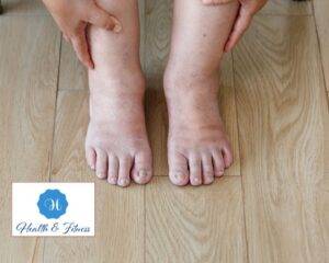 Swollen Legs, Ankles, or Feet