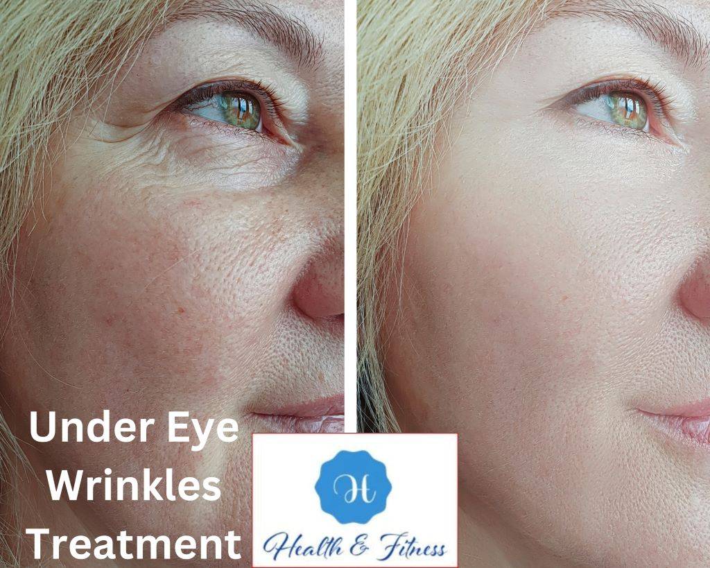 Under Eye Wrinkles Treatment