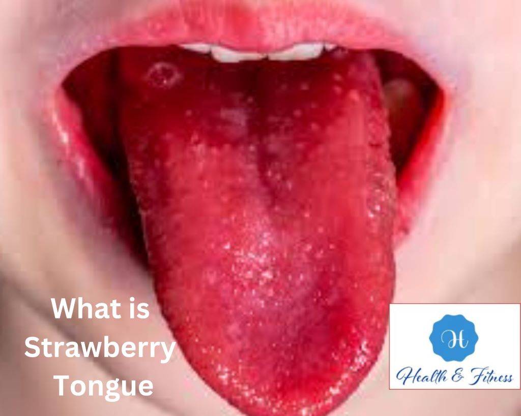 What is Strawberry Tongue