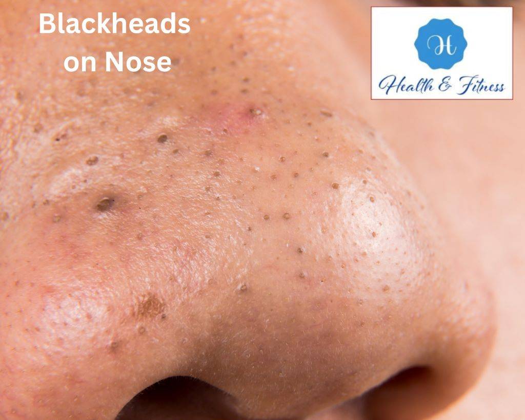 Blackheads on Nose