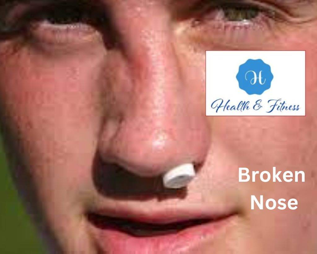 Broken Nose