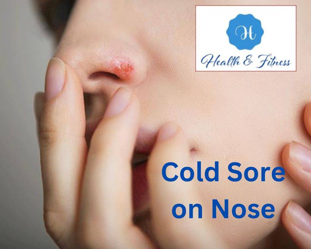 Cold Sore on Nose