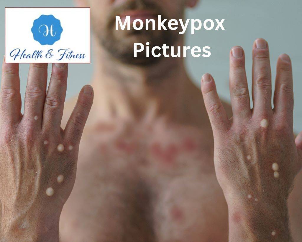 Monkeypox Pictures