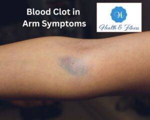 Blood Clot in Arm Symptoms