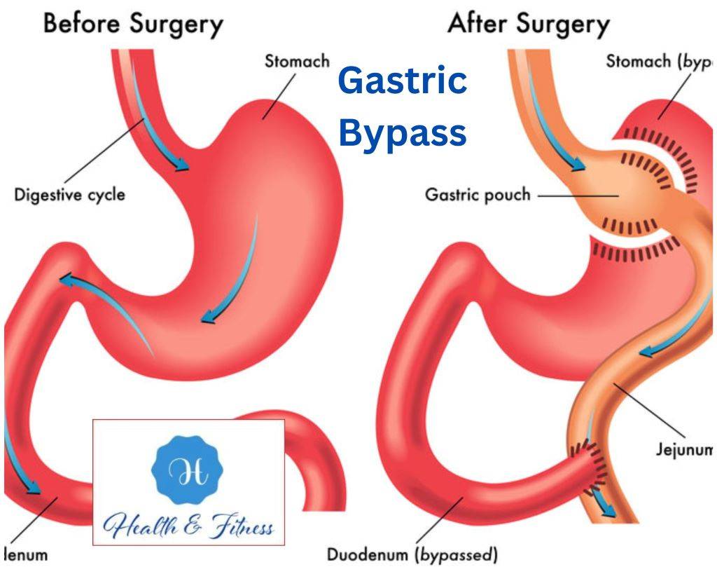 Gastric Bypass Your Path to Lasting Weight Loss