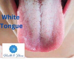 White Tongue