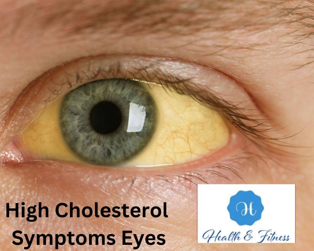 High Cholesterol Symptoms Eyes