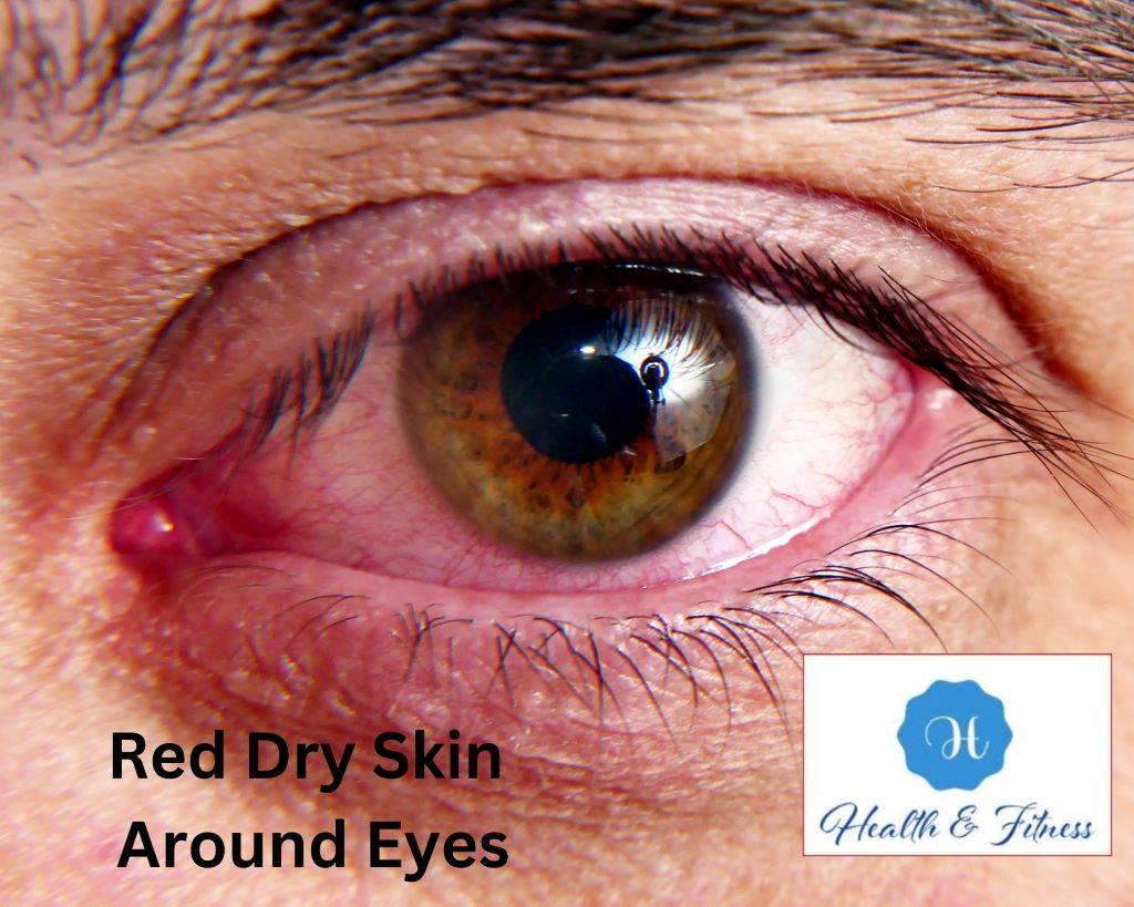 Red Dry Skin Around Eyes