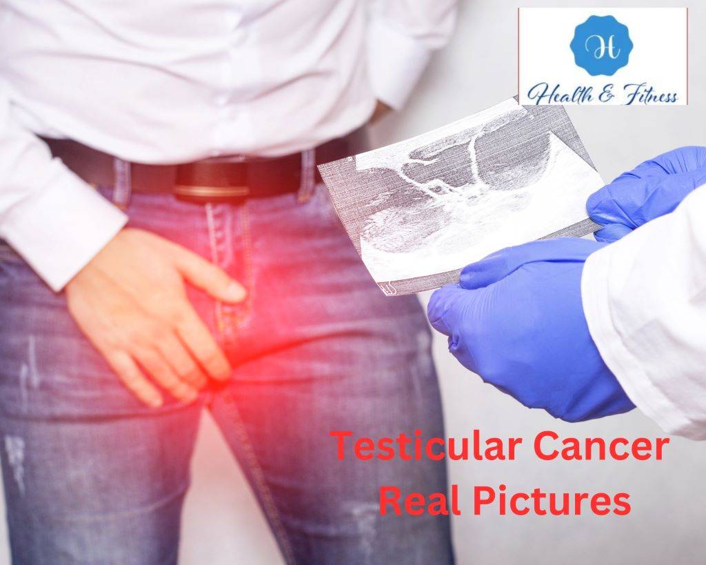 Testicular Cancer Real Pictures