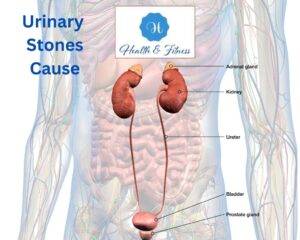 Urinary Stones Cause
