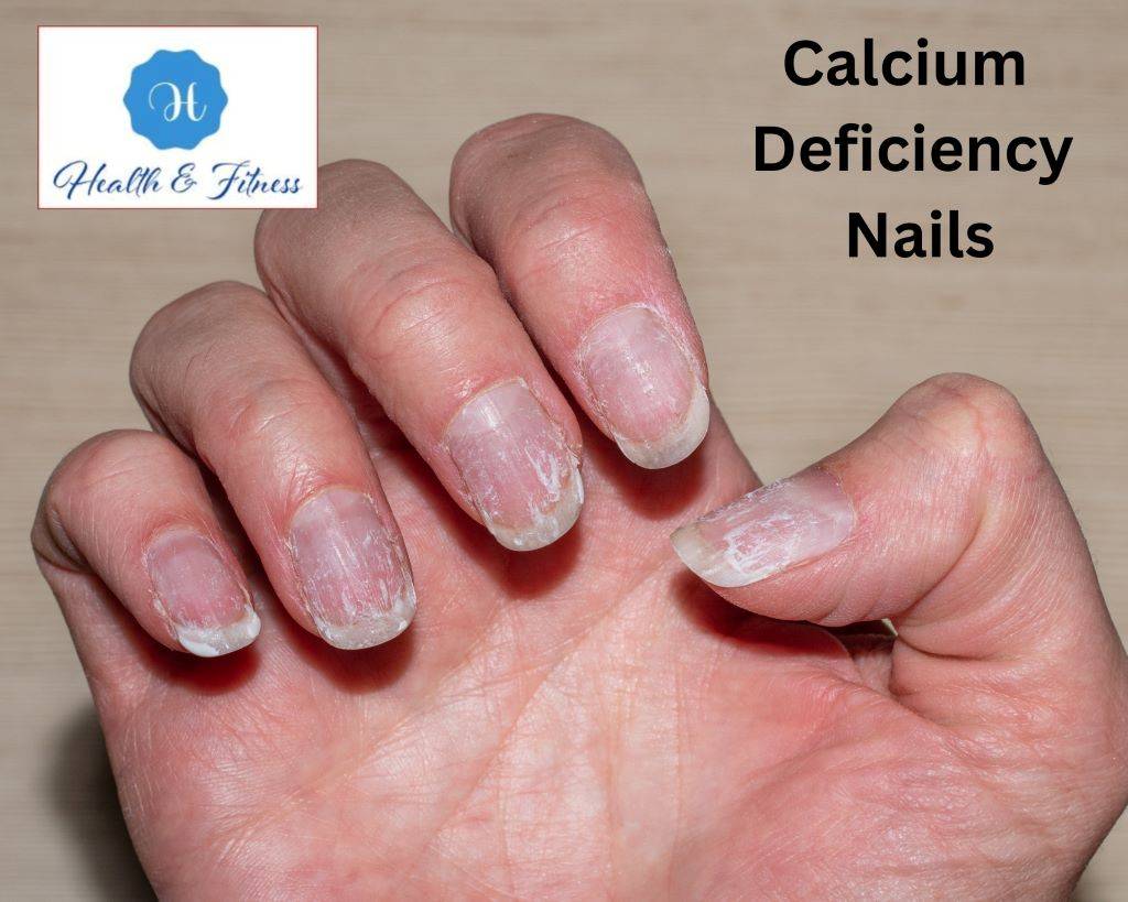 Calcium Deficiency Nails