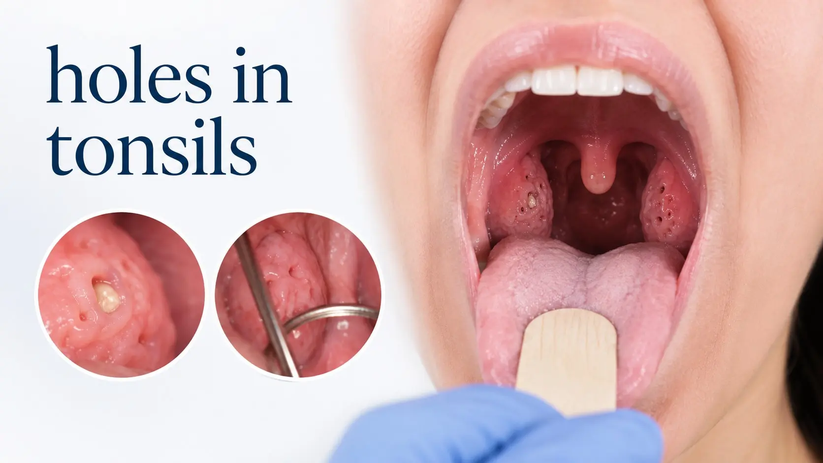 holes in tonsils- Open mouth showing natural tonsil crypts with a small tonsil stone and a clinical throat exam cue
