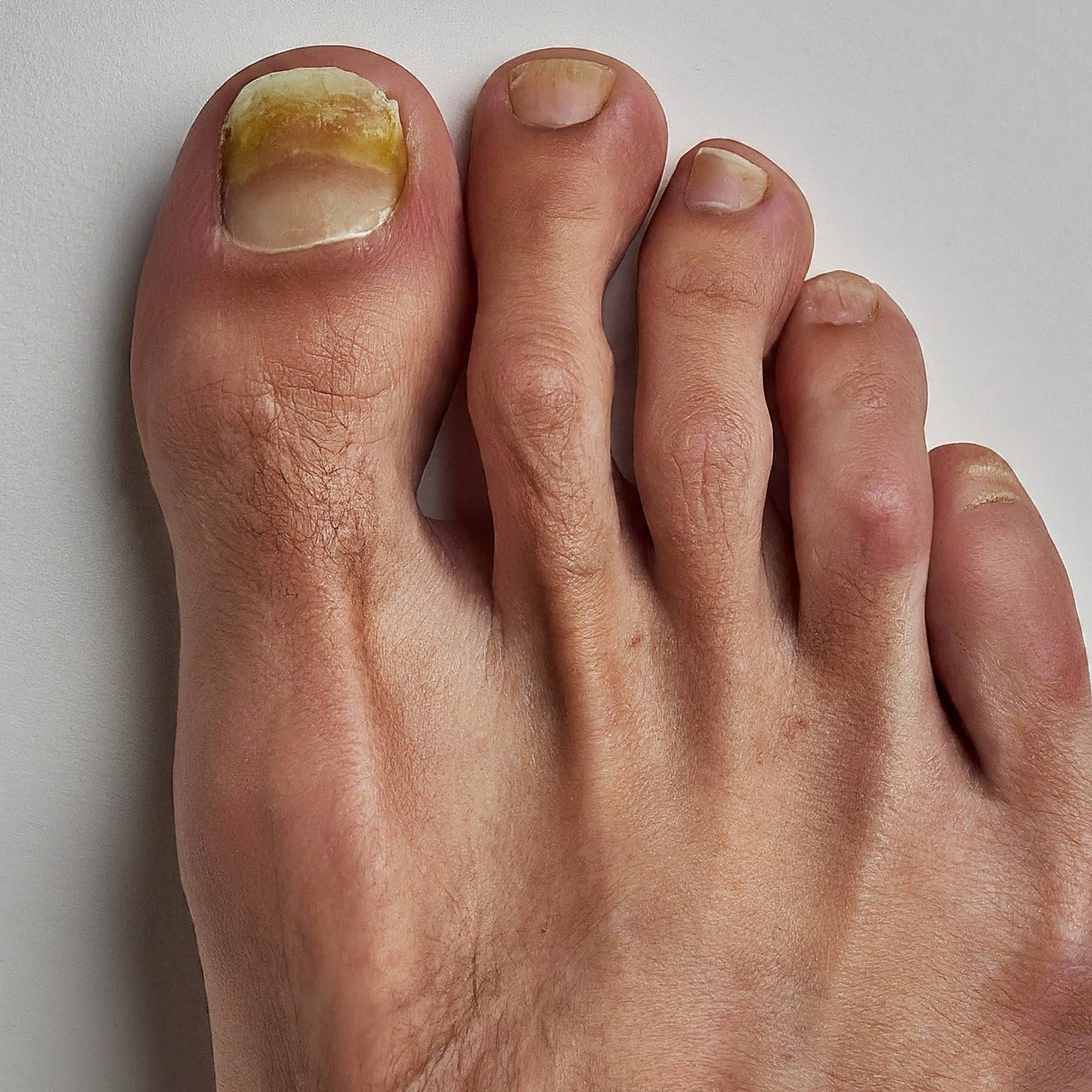 Early Stage Toenail Fungus