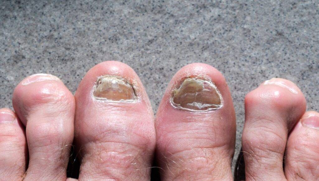 Foot Fungus Pictures Understanding Symptoms And Treatment Options Foot Fungus Pictures Understanding Symptoms And Treatment Options