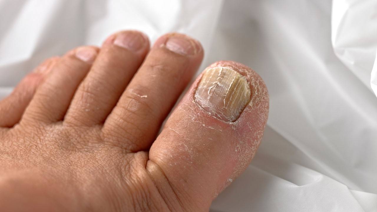 What Exactly is Early Stage Toenail Fungus